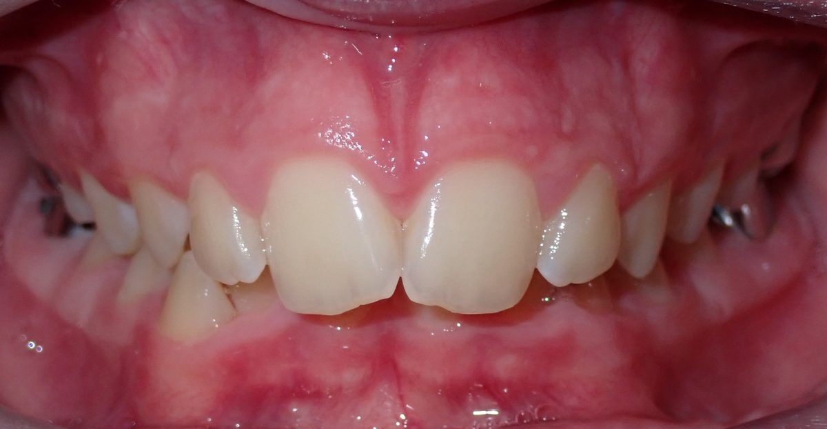 Vivid Smiles patient case 13 before and after treatment comparison before